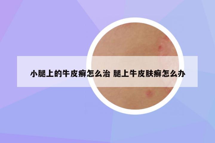 小腿上的牛皮癣怎么治 腿上牛皮肤癣怎么办
