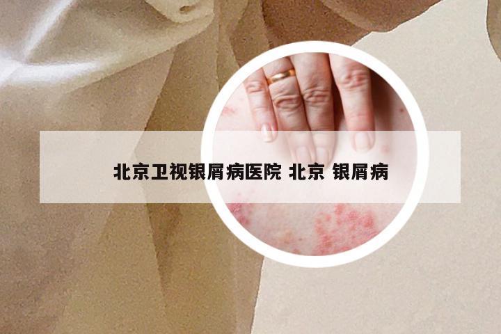 北京卫视银屑病医院 北京 银屑病