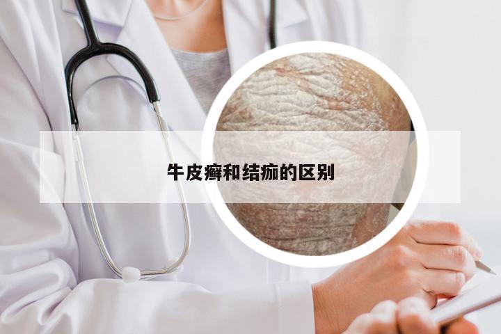 牛皮癣和结痂的区别