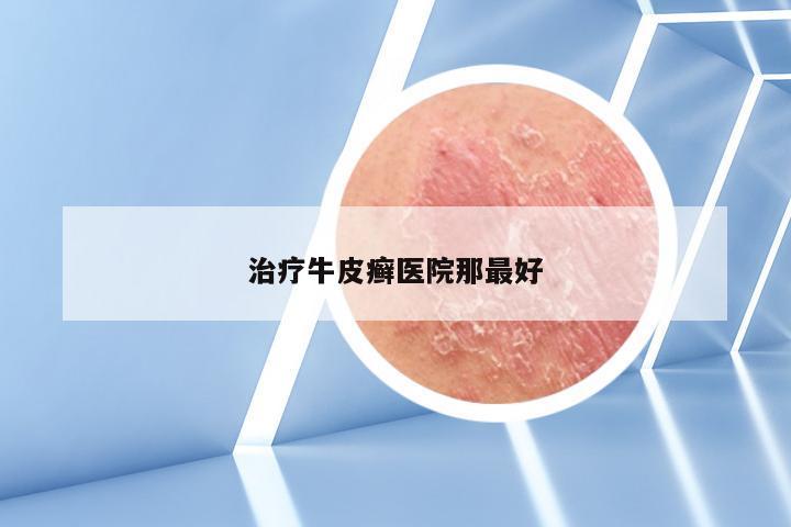 治疗牛皮癣医院那最好