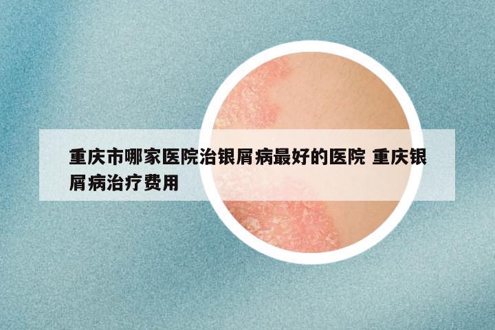 重庆市哪家医院治银屑病最好的医院 重庆银屑病治疗费用