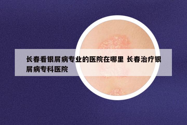 长春看银屑病专业的医院在哪里 长春治疗银屑病专科医院