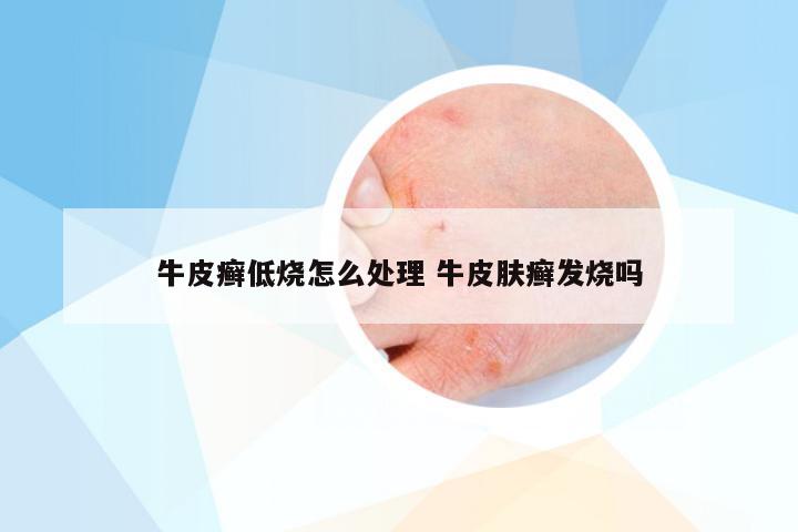 牛皮癣低烧怎么处理 牛皮肤癣发烧吗