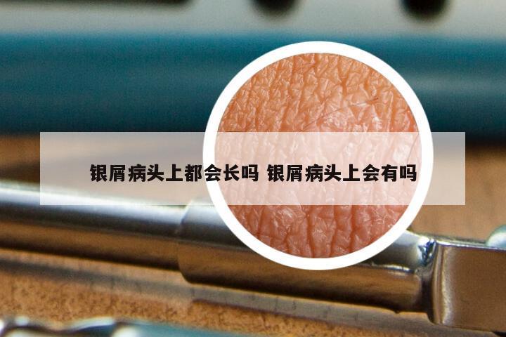 银屑病头上都会长吗 银屑病头上会有吗