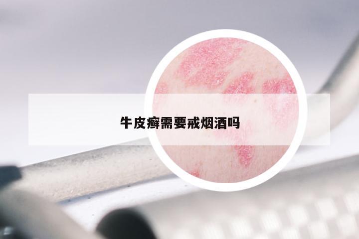 牛皮癣需要戒烟酒吗