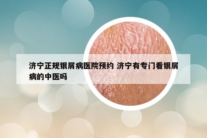 济宁正规银屑病医院预约 济宁有专门看银屑病的中医吗