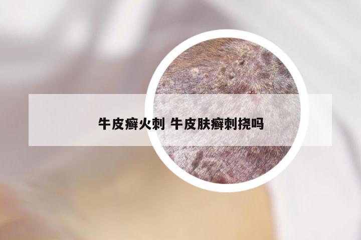 牛皮癣火刺 牛皮肤癣刺挠吗
