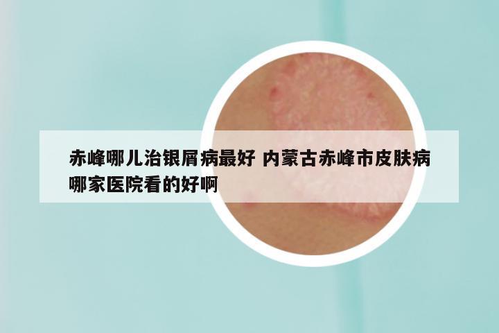 赤峰哪儿治银屑病最好 内蒙古赤峰市皮肤病哪家医院看的好啊