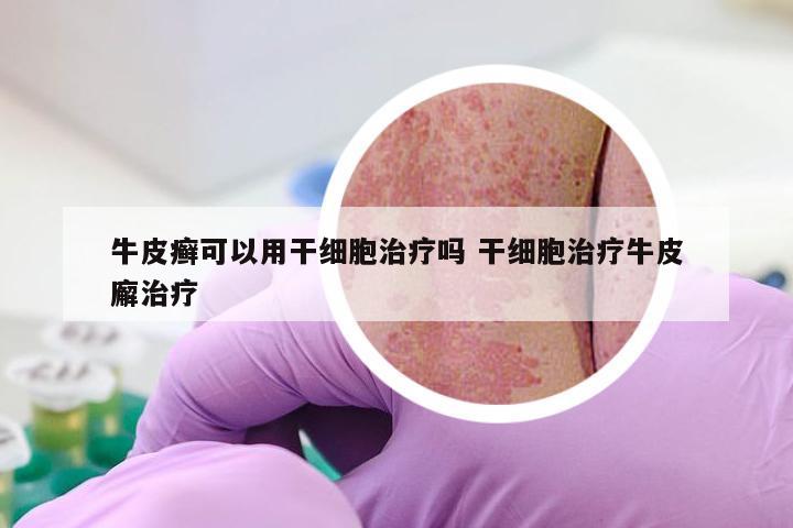 牛皮癣可以用干细胞治疗吗 干细胞治疗牛皮廨治疗