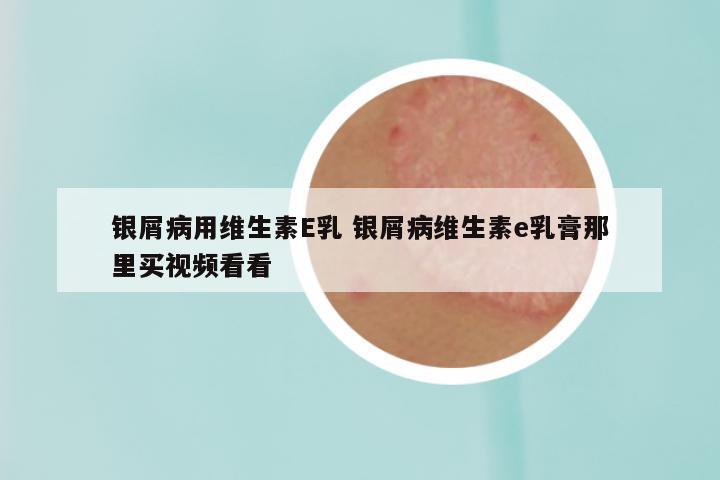 银屑病用维生素E乳 银屑病维生素e乳膏那里买视频看看