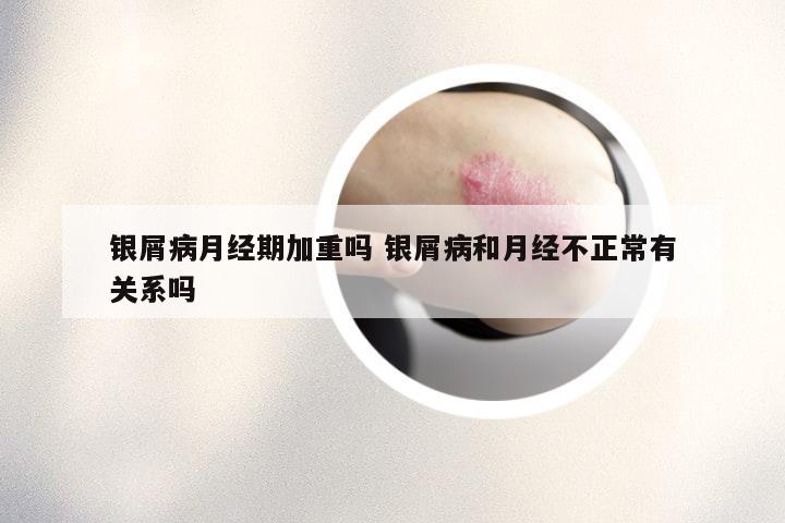 银屑病月经期加重吗 银屑病和月经不正常有关系吗