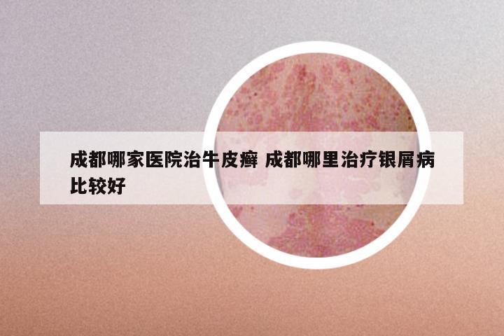成都哪家医院治牛皮癣 成都哪里治疗银屑病比较好