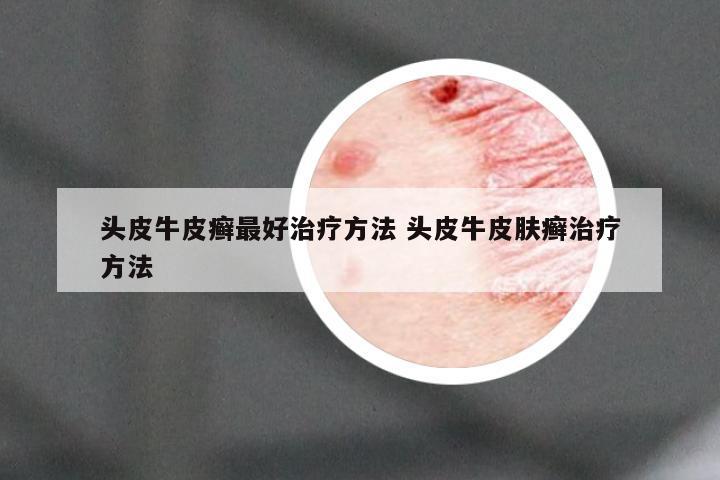 头皮牛皮癣最好治疗方法 头皮牛皮肤癣治疗方法
