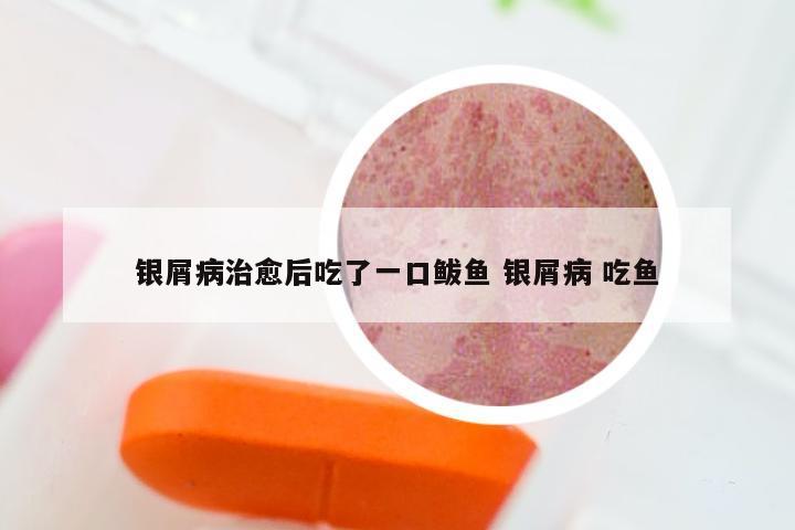银屑病治愈后吃了一口鲅鱼 银屑病 吃鱼