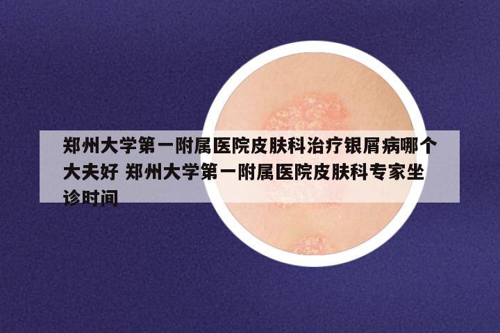 郑州大学第一附属医院皮肤科治疗银屑病哪个大夫好 郑州大学第一附属医院皮肤科专家坐诊时间