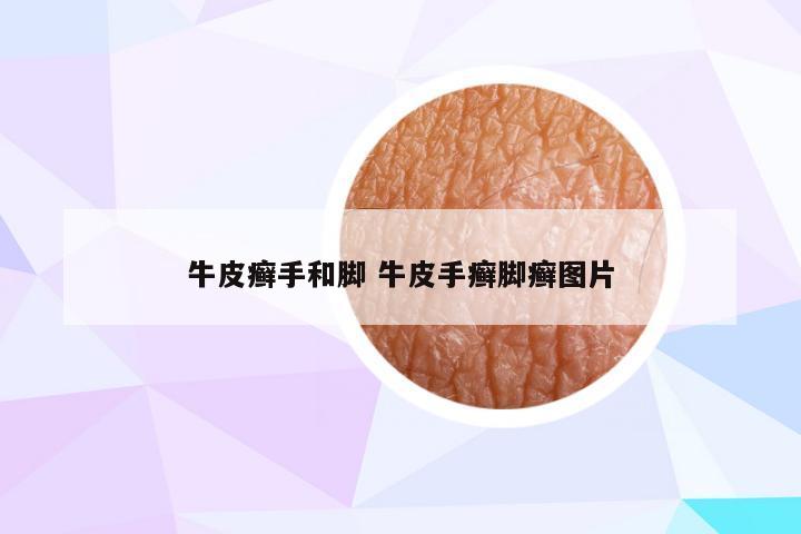 牛皮癣手和脚 牛皮手癣脚癣图片