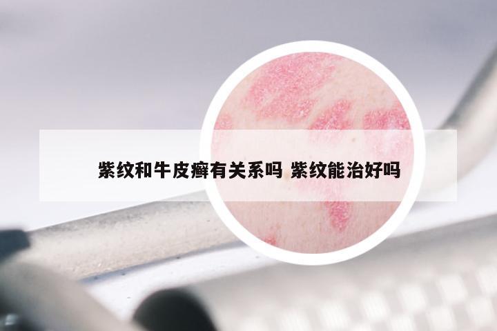 紫纹和牛皮癣有关系吗 紫纹能治好吗