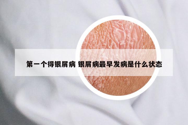 第一个得银屑病 银屑病最早发病是什么状态