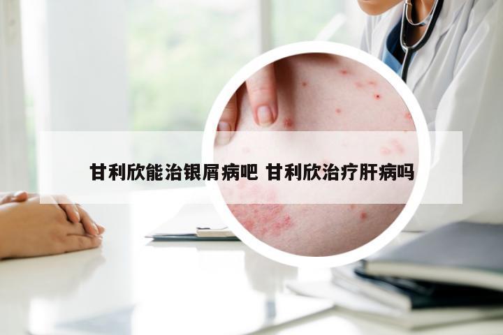 甘利欣能治银屑病吧 甘利欣治疗肝病吗