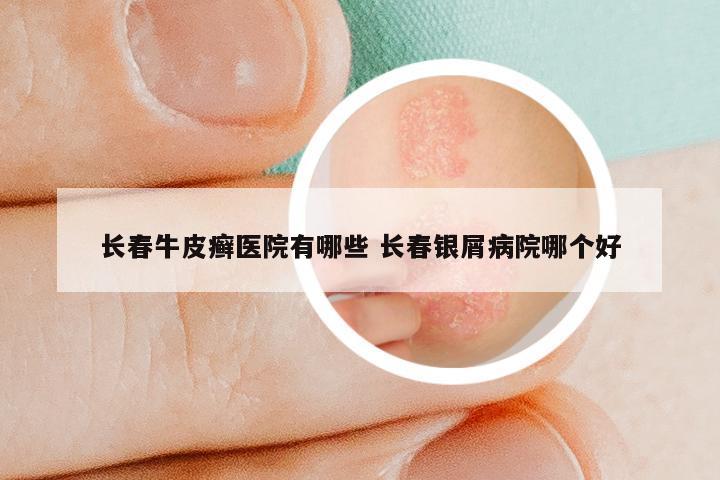 长春牛皮癣医院有哪些 长春银屑病院哪个好