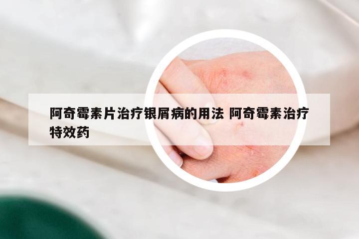阿奇霉素片治疗银屑病的用法 阿奇霉素治疗特效药