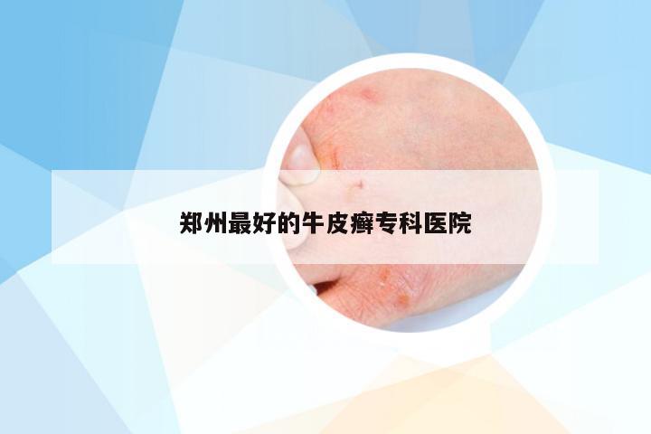 郑州最好的牛皮癣专科医院
