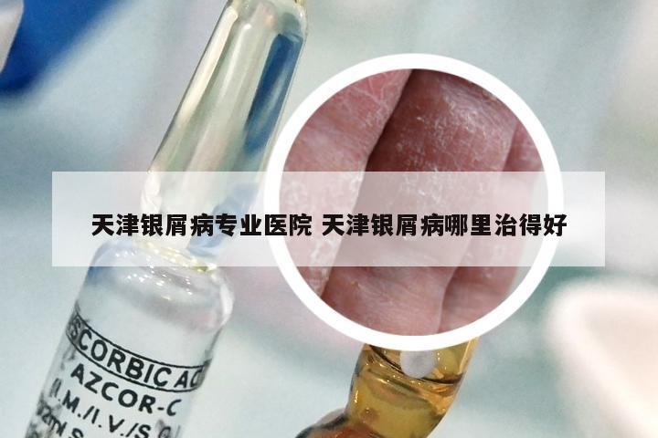 天津银屑病专业医院 天津银屑病哪里治得好