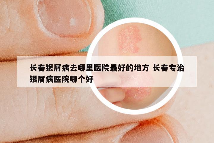 长春银屑病去哪里医院最好的地方 长春专治银屑病医院哪个好