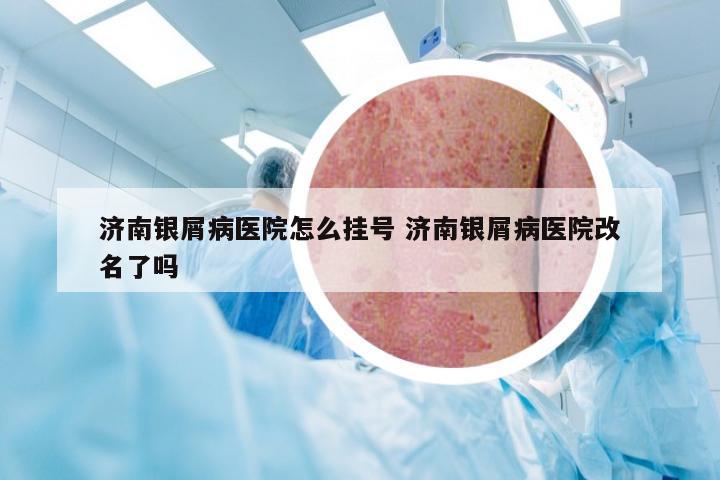 济南银屑病医院怎么挂号 济南银屑病医院改名了吗