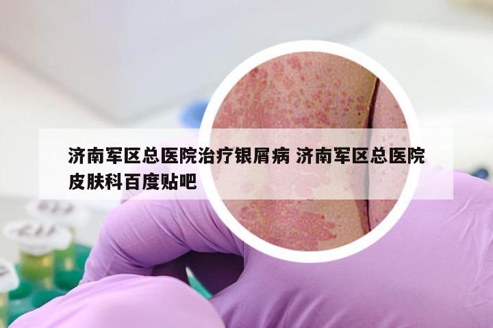 济南军区总医院治疗银屑病 济南军区总医院皮肤科百度贴吧