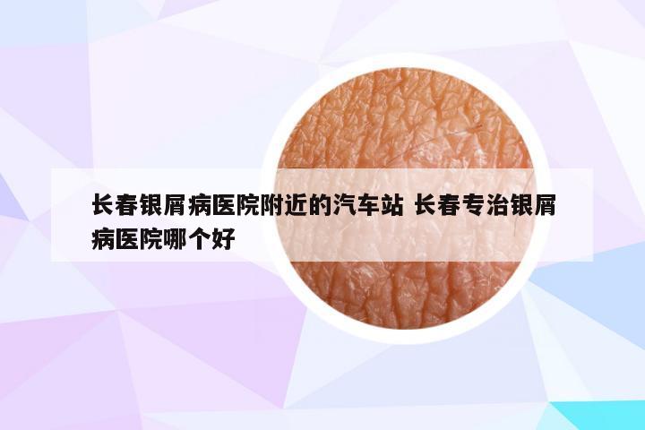 长春银屑病医院附近的汽车站 长春专治银屑病医院哪个好