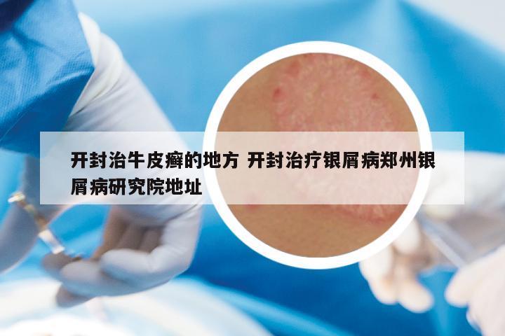 开封治牛皮癣的地方 开封治疗银屑病郑州银屑病研究院地址