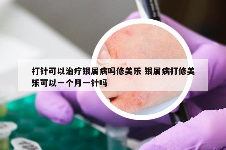打针可以治疗银屑病吗修美乐 银屑病打修美乐可以一个月一针吗