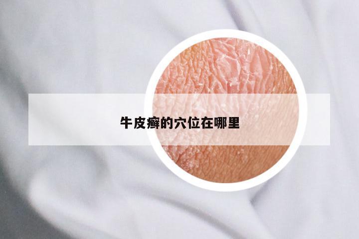 牛皮癣的穴位在哪里