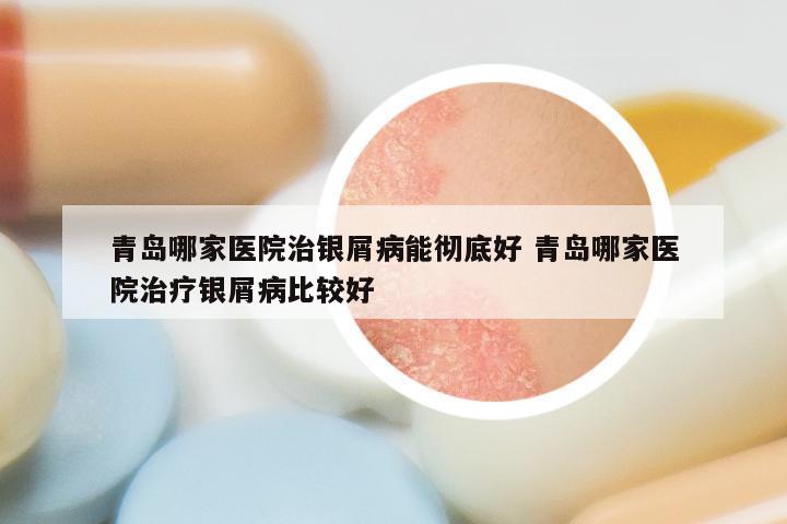 青岛哪家医院治银屑病能彻底好 青岛哪家医院治疗银屑病比较好