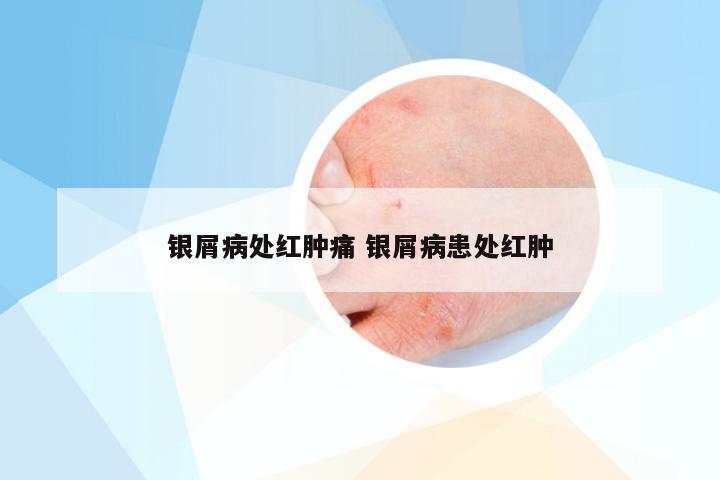 银屑病处红肿痛 银屑病患处红肿