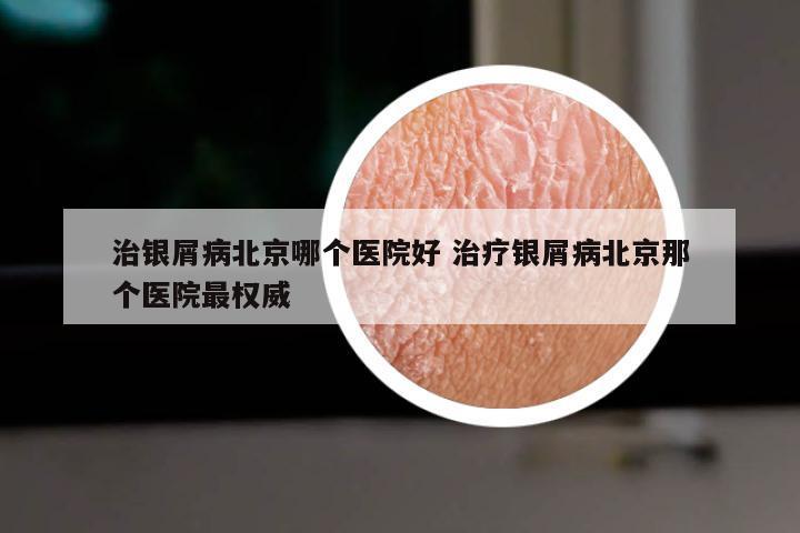 治银屑病北京哪个医院好 治疗银屑病北京那个医院最权威