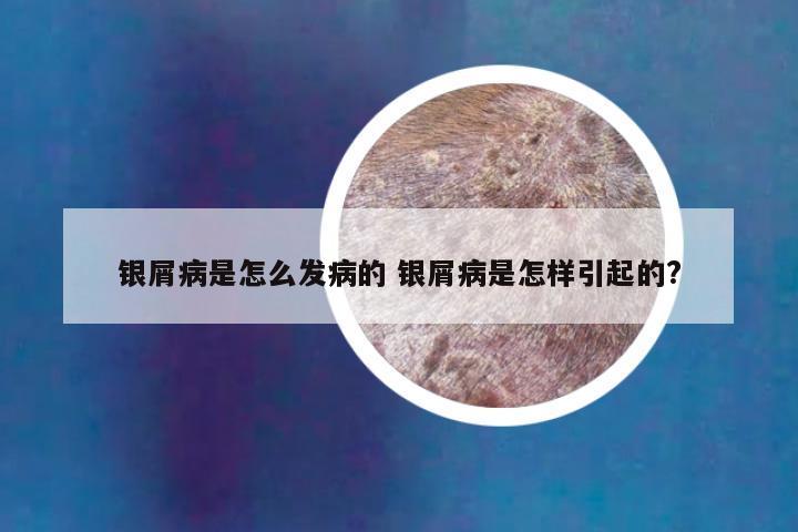 银屑病是怎么发病的 银屑病是怎样引起的?