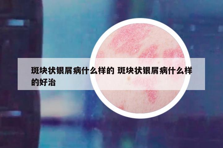 斑块状银屑病什么样的 斑块状银屑病什么样的好治