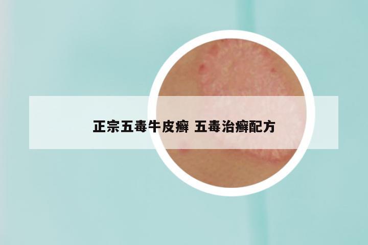 正宗五毒牛皮癣 五毒治癣配方
