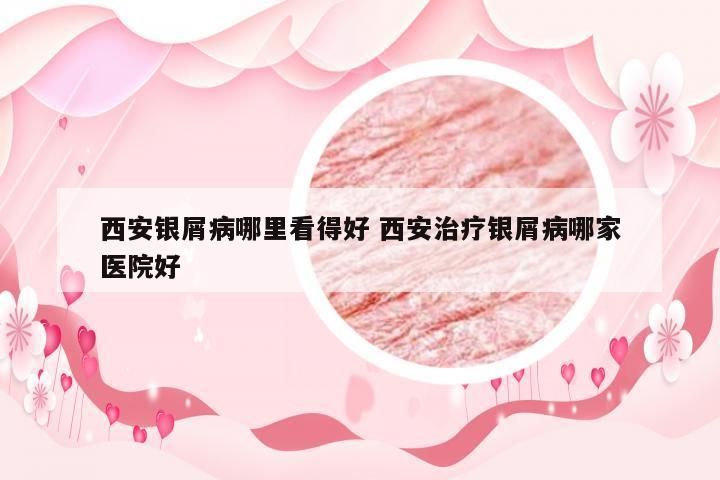 西安银屑病哪里看得好 西安治疗银屑病哪家医院好