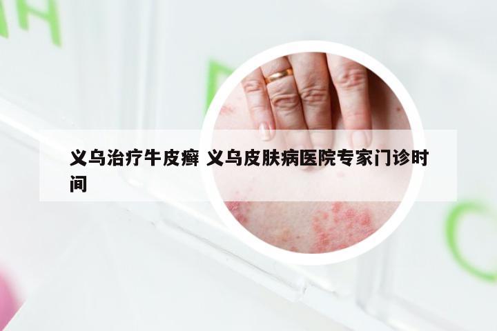 义乌治疗牛皮癣 义乌皮肤病医院专家门诊时间