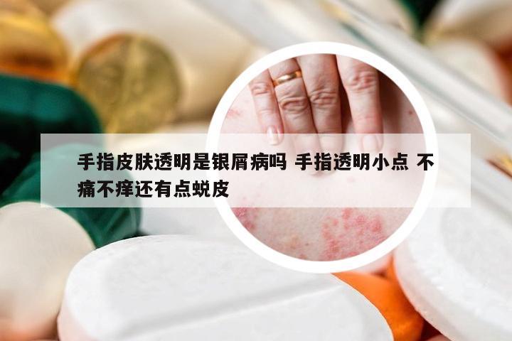 手指皮肤透明是银屑病吗 手指透明小点 不痛不痒还有点蜕皮