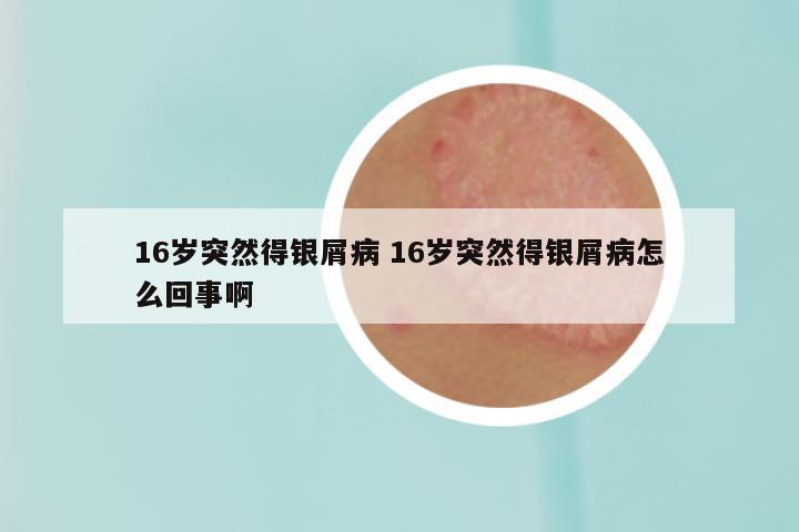 16岁突然得银屑病 16岁突然得银屑病怎么回事啊