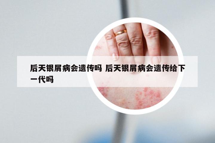 后天银屑病会遗传吗 后天银屑病会遗传给下一代吗