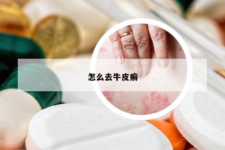怎么去牛皮癣