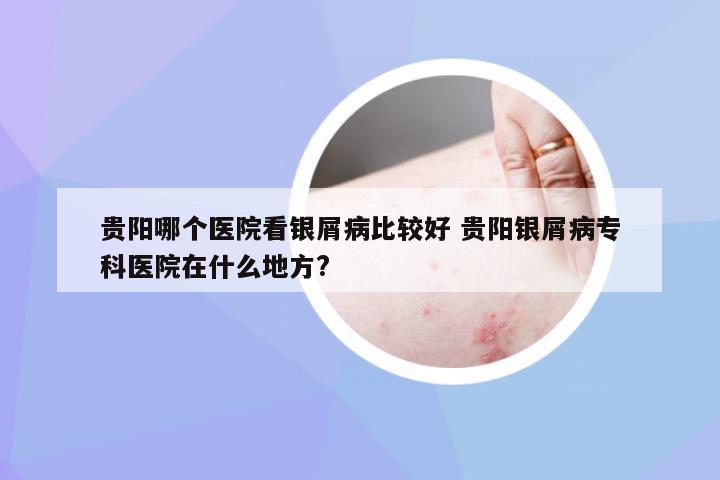 贵阳哪个医院看银屑病比较好 贵阳银屑病专科医院在什么地方?