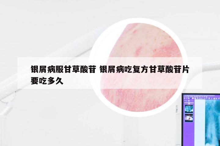 银屑病服甘草酸苷 银屑病吃复方甘草酸苷片要吃多久