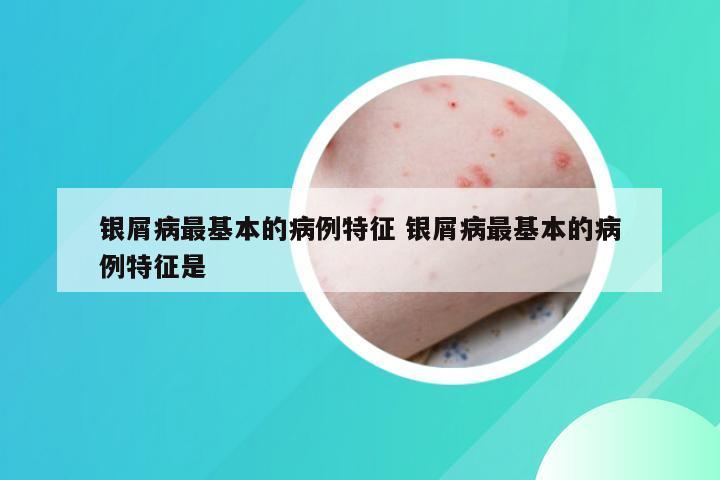 银屑病最基本的病例特征 银屑病最基本的病例特征是