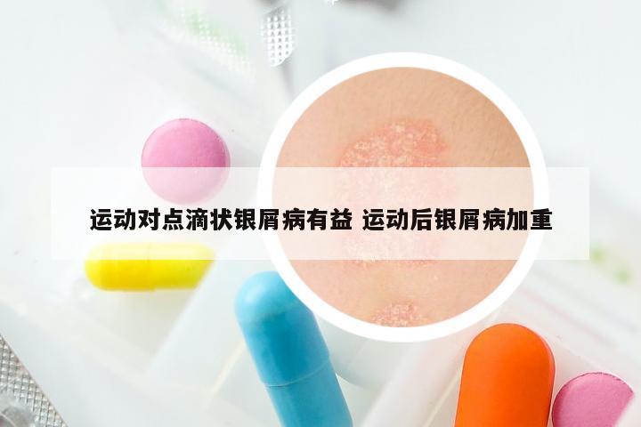 运动对点滴状银屑病有益 运动后银屑病加重
